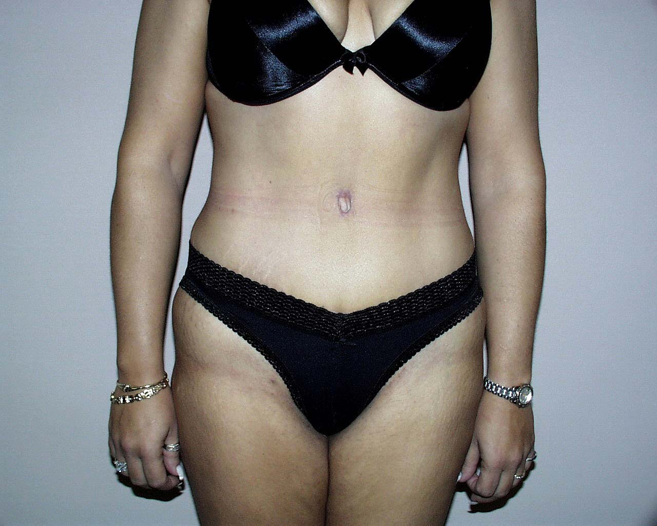 Tummy Tuck Before & After Patient #4044