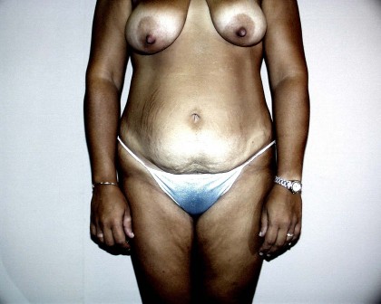 Tummy Tuck Before & After Patient #4044