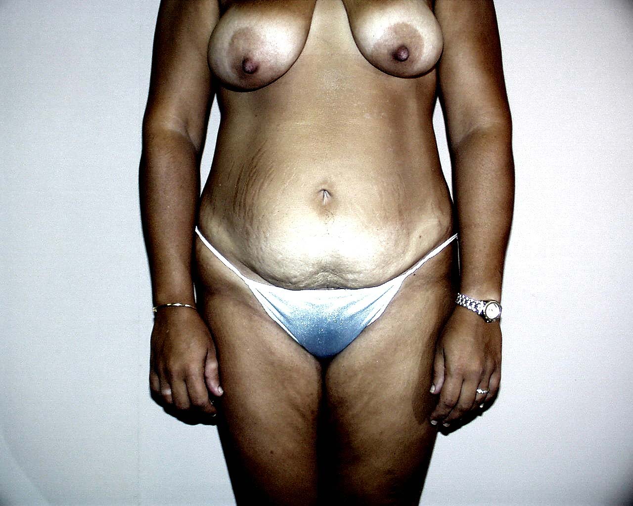 Tummy Tuck Before & After Patient #4044