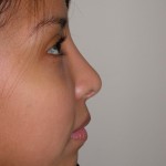 Rhinoplasty Before & After Patient #4165