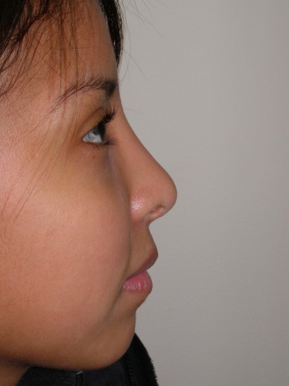 Rhinoplasty Before & After Patient #4165