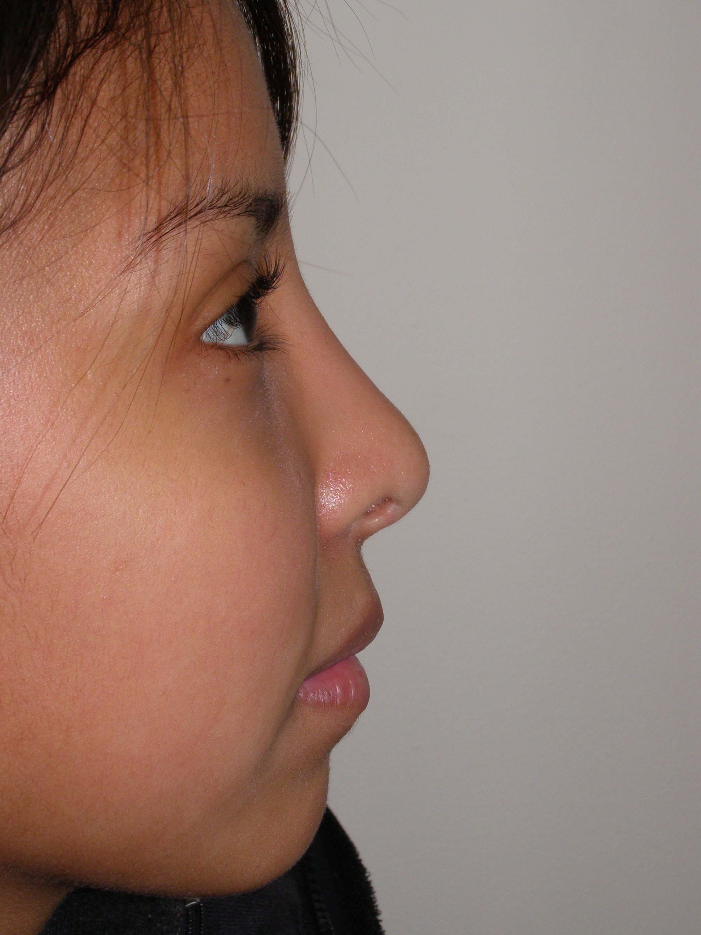 Rhinoplasty Before & After Patient #4165