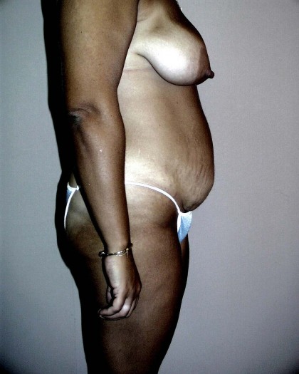 Tummy Tuck Before & After Patient #4044