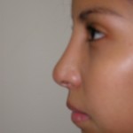Rhinoplasty Before & After Patient #4165