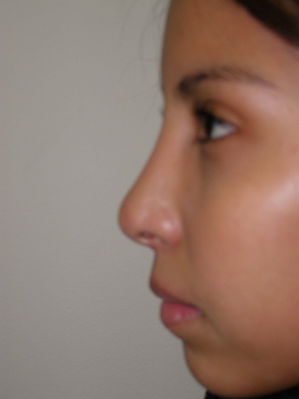 Rhinoplasty Before & After Patient #4165