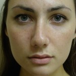 Rhinoplasty Before & After Patient #4180