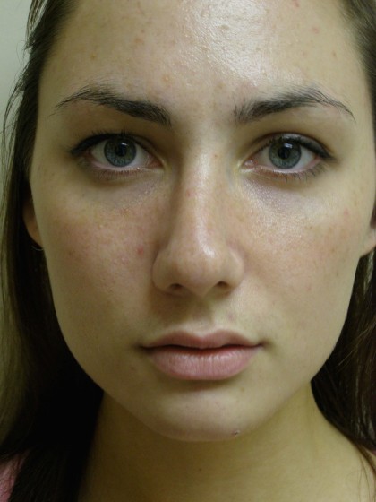 Rhinoplasty Before & After Patient #4180