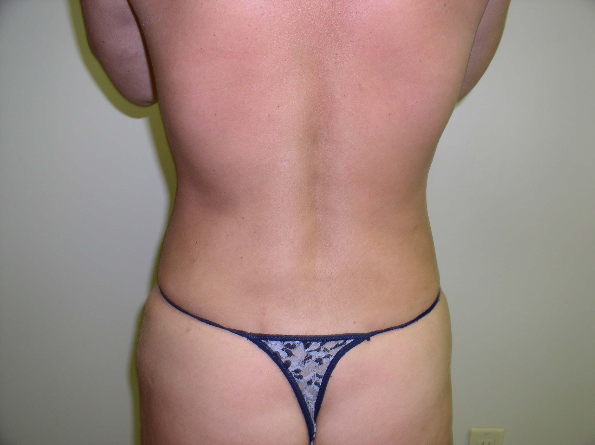 Liposuction Before & After Patient #3975