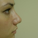 Rhinoplasty Before & After Patient #4180