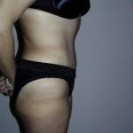 Tummy Tuck Before & After Patient #4044