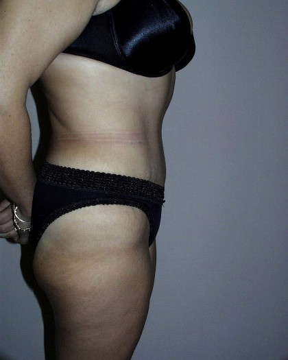 Tummy Tuck Before & After Patient #4044