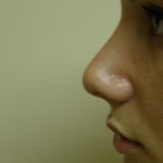 Rhinoplasty Before & After Patient #4180
