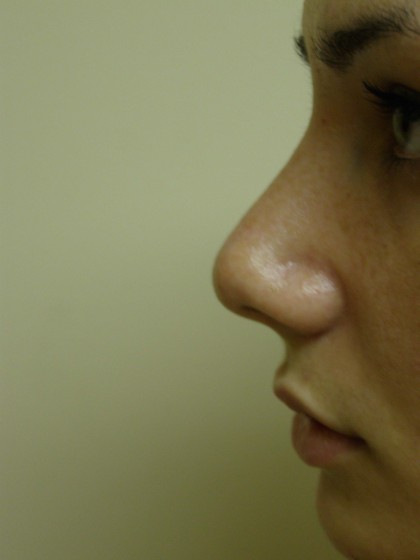 Rhinoplasty Before & After Patient #4180