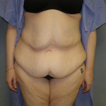 Tummy Tuck Before & After Patient #4054