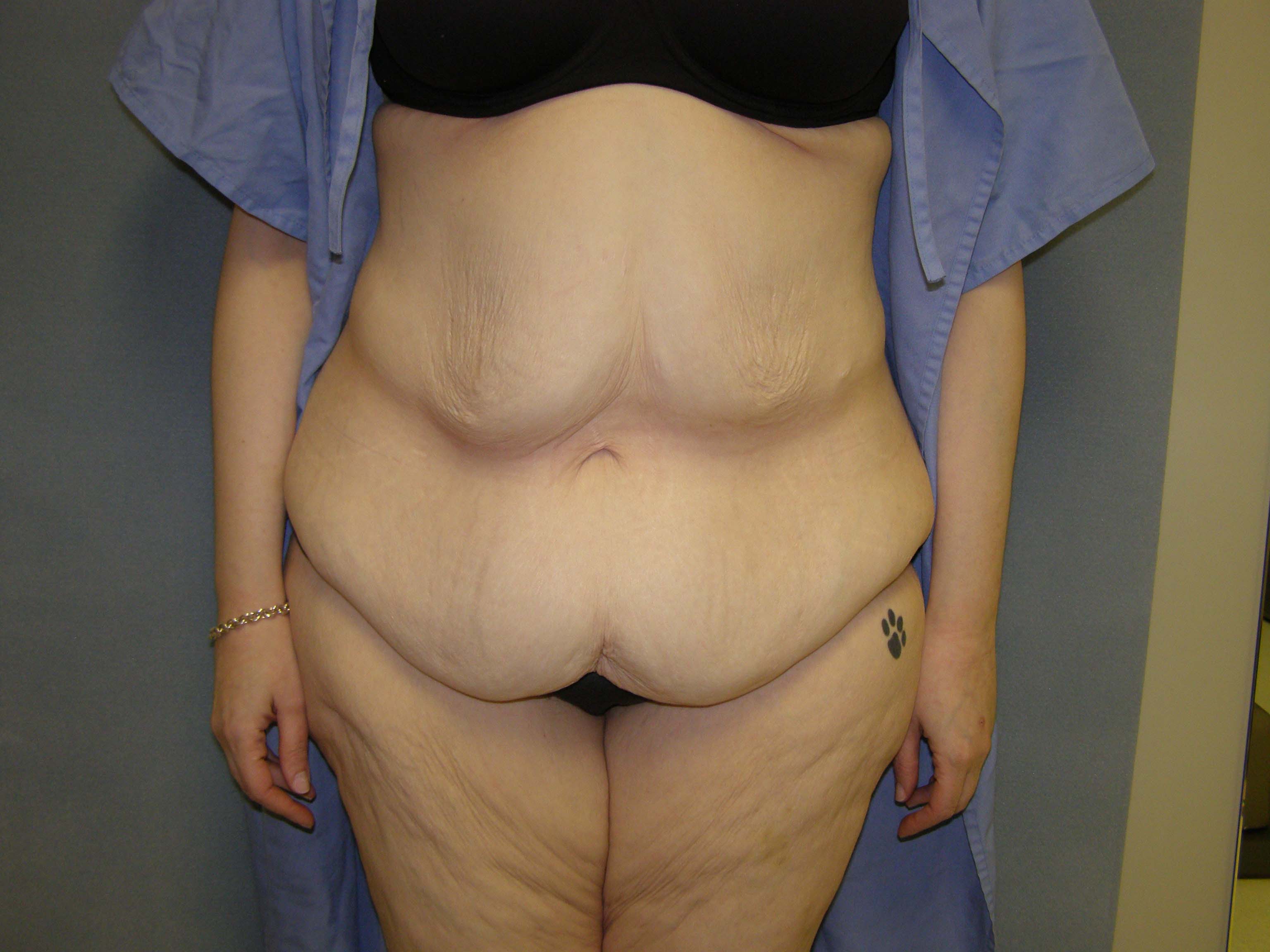 Tummy Tuck Before & After Patient #4054