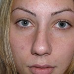 Rhinoplasty Before & After Patient #4180