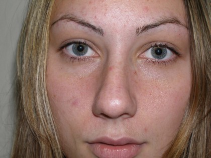Rhinoplasty Before & After Patient #4180