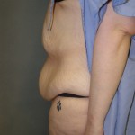 Tummy Tuck Before & After Patient #4054