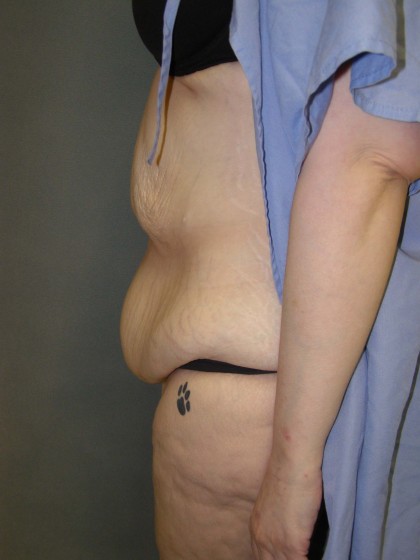 Tummy Tuck Before & After Patient #4054