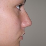 Rhinoplasty Before & After Patient #4180