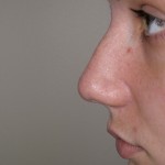 Rhinoplasty Before & After Patient #4180