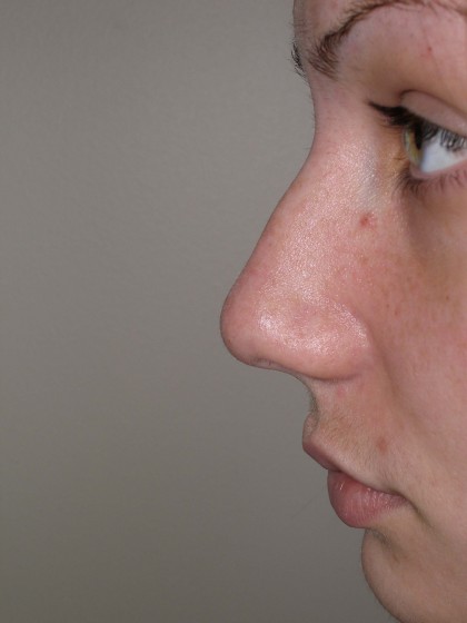 Rhinoplasty Before & After Patient #4180