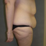 Tummy Tuck Before & After Patient #4054
