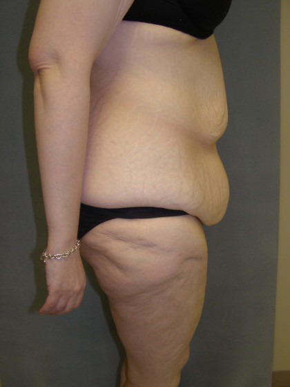 Tummy Tuck Before & After Patient #4054