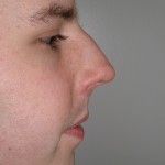 Rhinoplasty Before & After Patient #4195