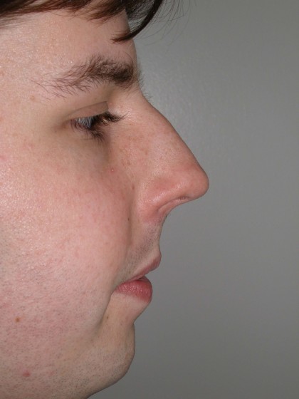 Rhinoplasty Before & After Patient #4195