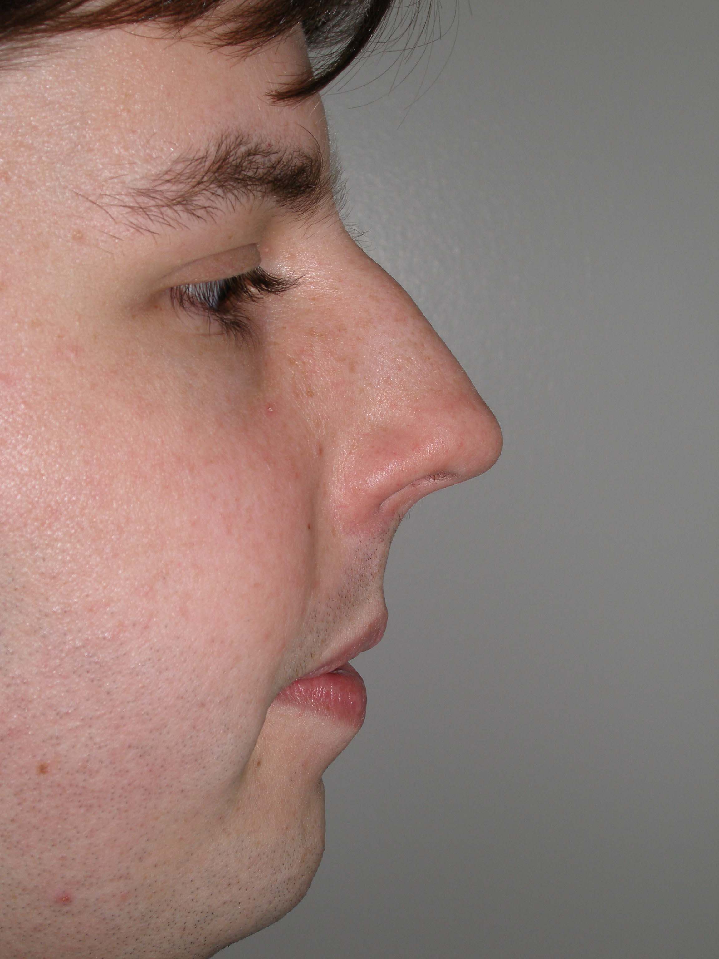Rhinoplasty Before & After Patient #4195