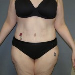 Tummy Tuck Before & After Patient #4054