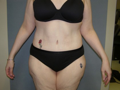 Tummy Tuck Before & After Patient #4054