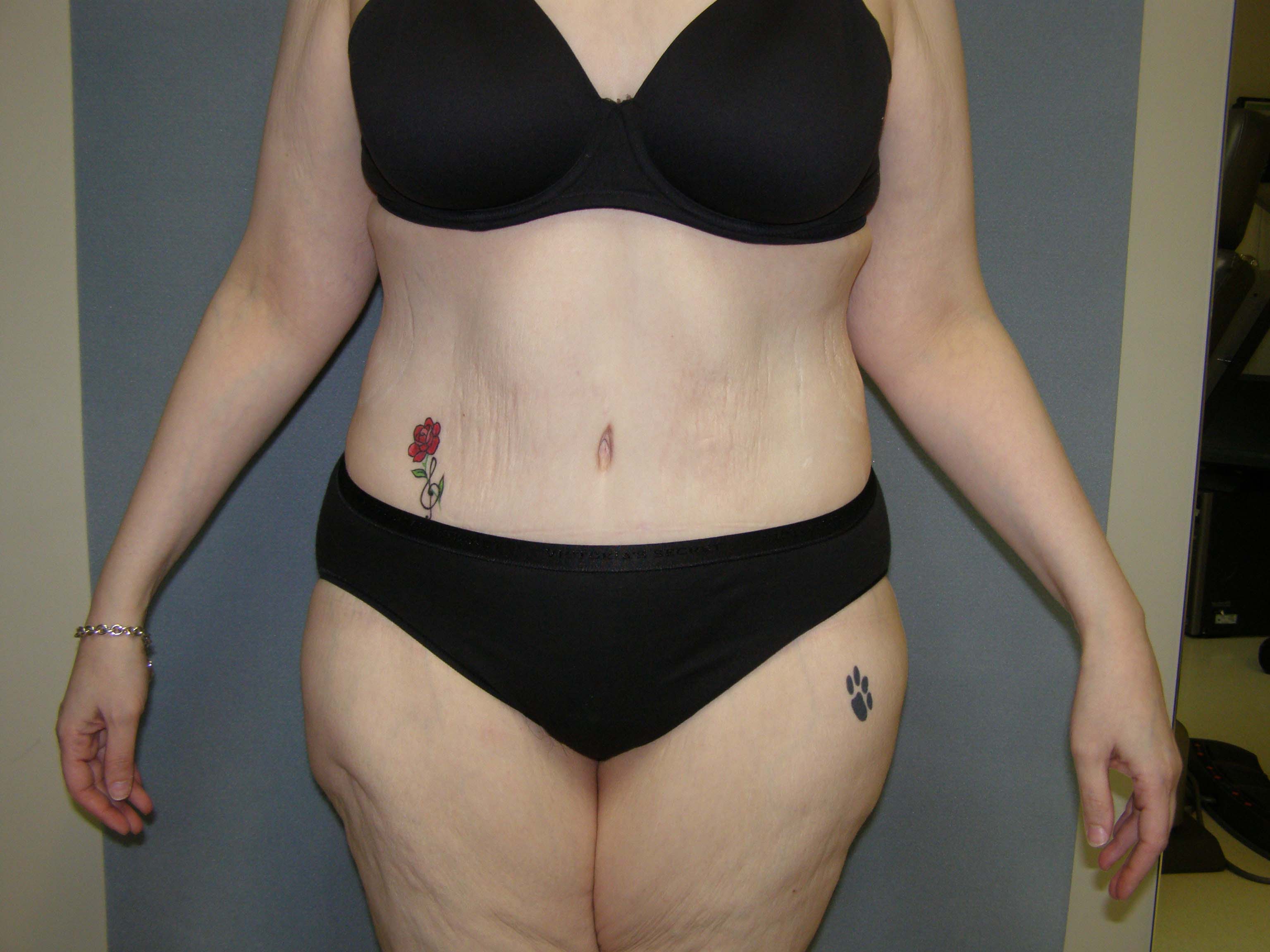 Tummy Tuck Before & After Patient #4054