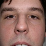 Rhinoplasty Before & After Patient #4195