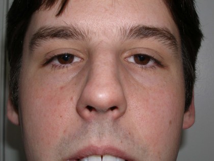 Rhinoplasty Before & After Patient #4195