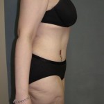 Tummy Tuck Before & After Patient #4054