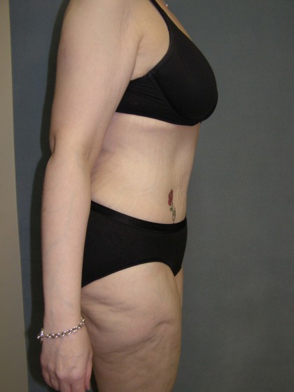 Tummy Tuck Before & After Patient #4054