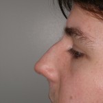 Rhinoplasty Before & After Patient #4195