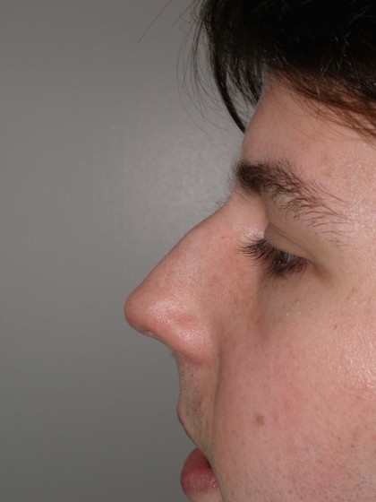 Rhinoplasty Before & After Patient #4195