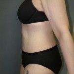 Tummy Tuck Before & After Patient #4054