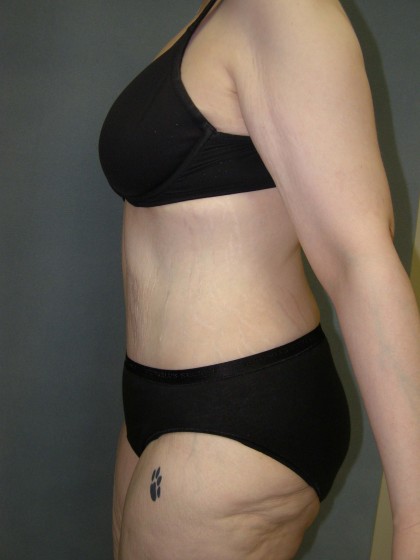 Tummy Tuck Before & After Patient #4054