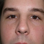 Rhinoplasty Before & After Patient #4195