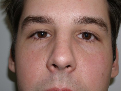 Rhinoplasty Before & After Patient #4195