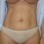 Tummy Tuck Before & After Patient #4065