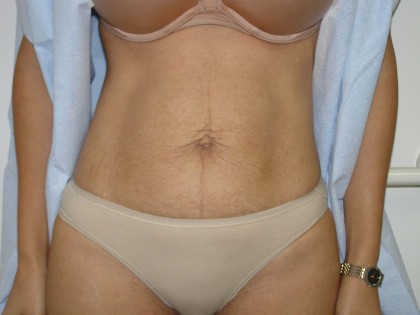 Tummy Tuck Before & After Patient #4065
