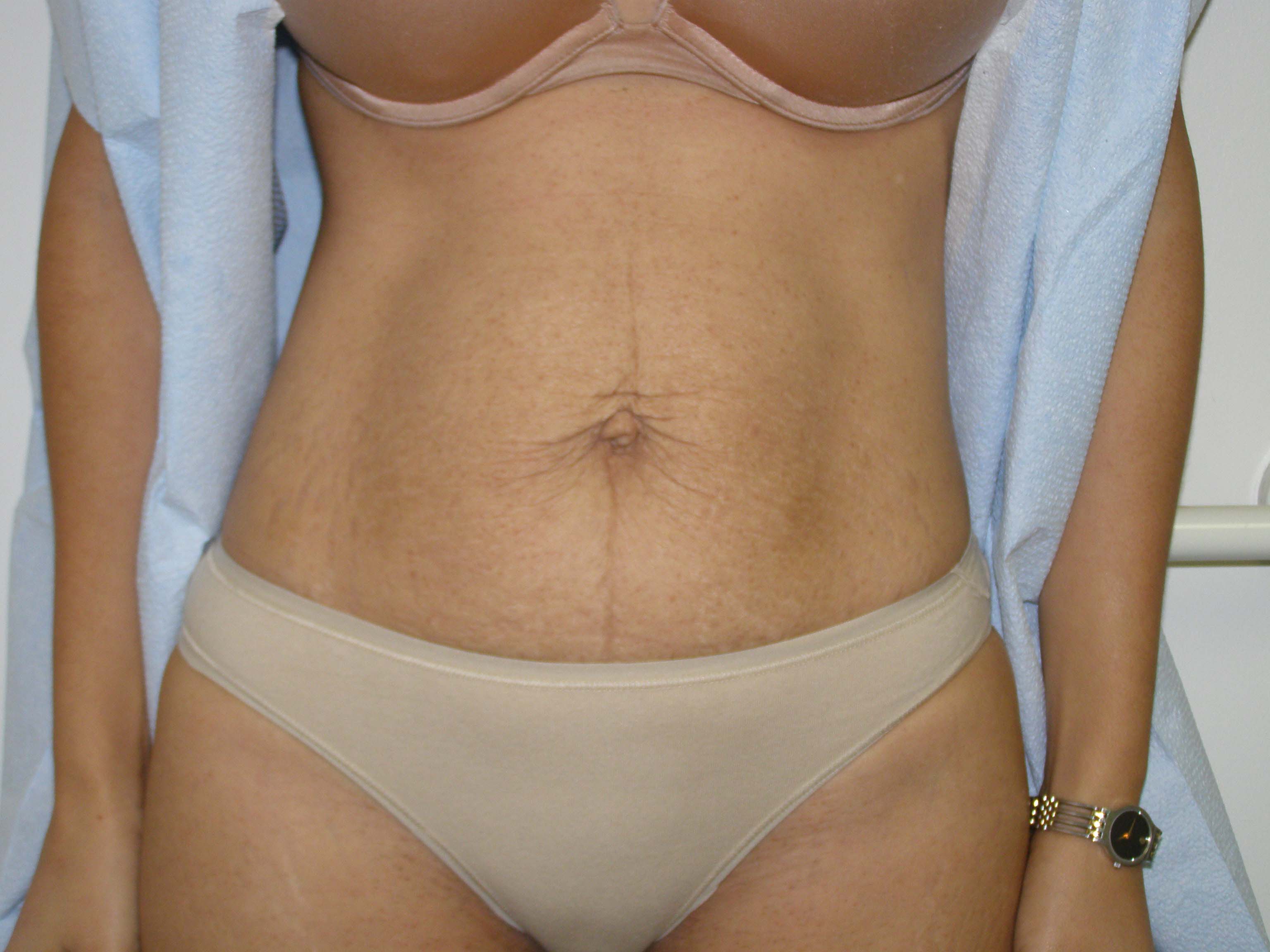 Tummy Tuck Before & After Patient #4065