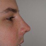 Rhinoplasty Before & After Patient #4195