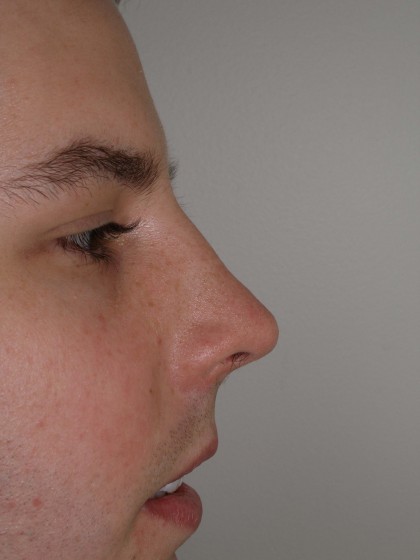 Rhinoplasty Before & After Patient #4195