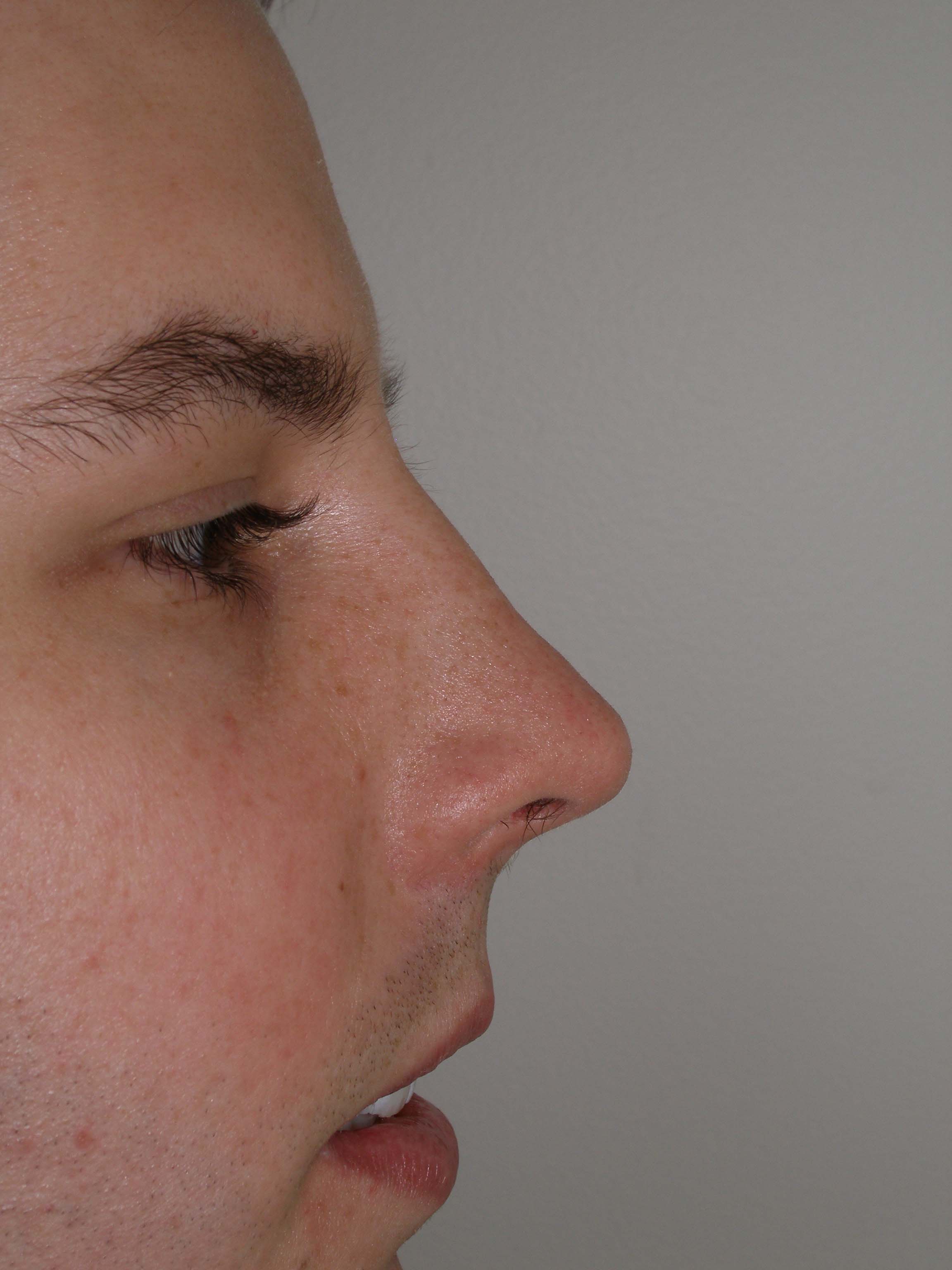 Rhinoplasty Before & After Patient #4195